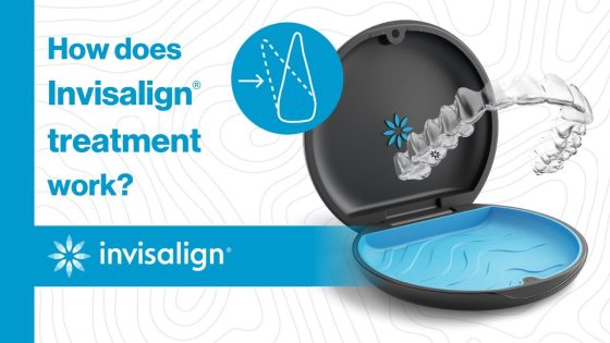 how does invisalign treatment work thumbnail